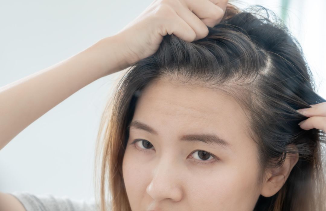 머리카락을 가르고 두피에 생긴 작은 뾰루지를 확인하는 사람